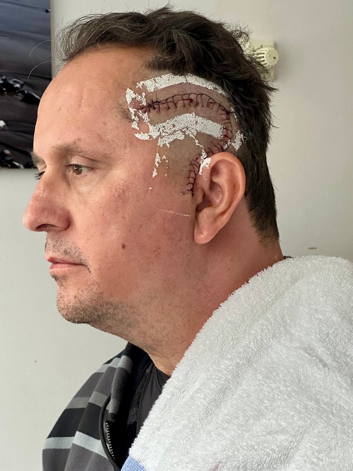 Jason had brain surgery to remove a 2.6cm tumour last August